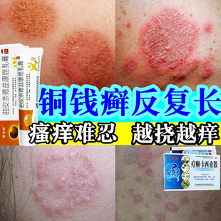 铜钱癣体癣牛皮癣专用药膏皮肤癣痒股癣大腿外用抑菌藓真菌感染WM