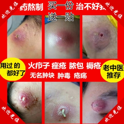 闷头火疖子屁股硬块拔毒坐板疮拔脓拔毒膏浓疮包毛囊