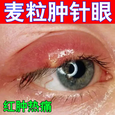 金霉素眼药水皮肤疖肿睑缘炎麦粒肿细菌性结膜炎细菌性眼睑角膜炎