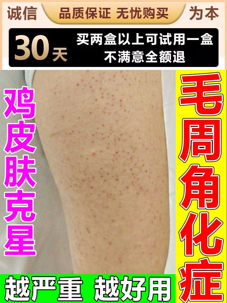 去鸡皮肤疙瘩毛囊角化药膏儿童脸部腿上胳膊上小疙瘩毛囊炎身体乳