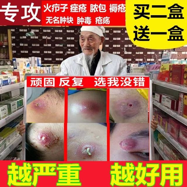 拔毒膏治火疖子屁股坐板疮肿硬块药祛火疖子浓疮包