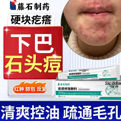 下巴反复长石头痘红肿硬块