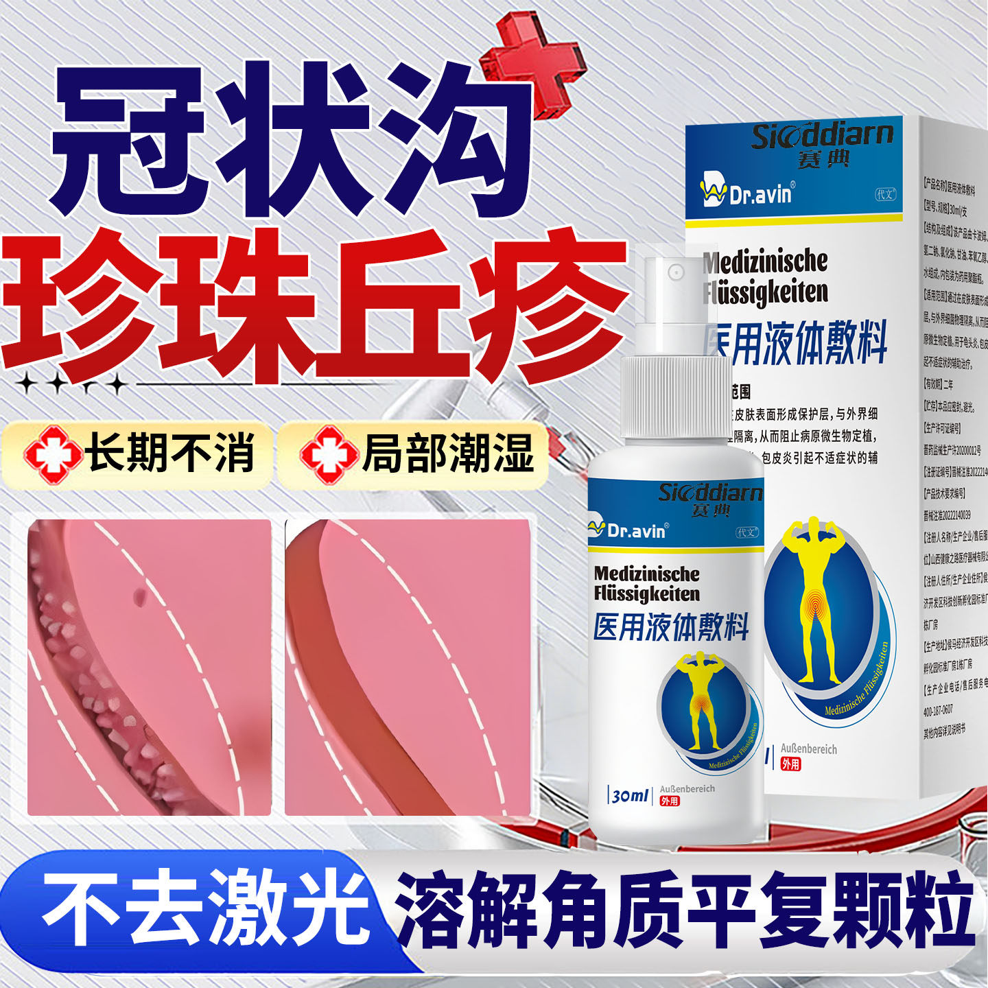 龟头炎症冠状沟珍珠疹去除专用系带旁丘疹颗粒喷剂真菌感染膏ZY