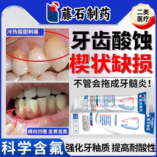 牙齿酸蚀引起牙齿楔状缺损搭修补牙根牙釉质腐蚀敏感牙齿防龋膏ON