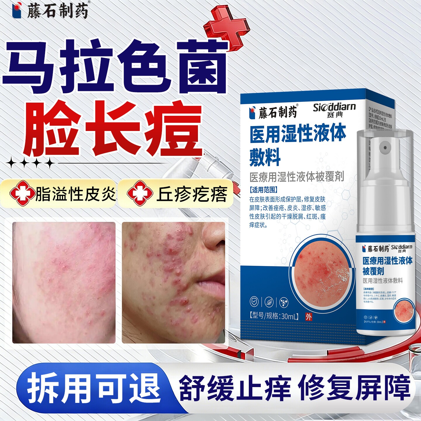 马拉色菌脸部脂溢性皮炎毛囊炎螨虫去脸上痘面部非药膏痤疮喷雾YU