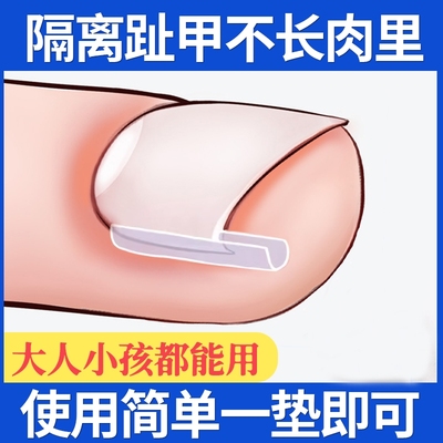 脚趾指甲矫正器甲沟炎隔离填充垫片嵌甲神器防止指甲往肉里长专用