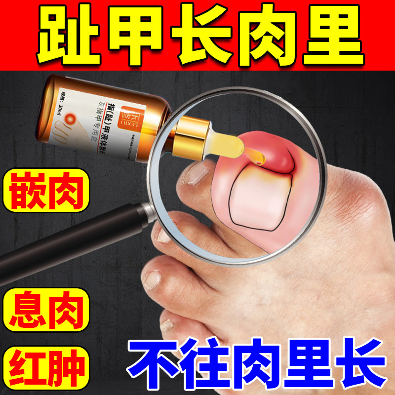 甲沟专用膏药贴指甲长肉里红肿疼痛肉芽嵌甲灰指甲流脓肿冷敷凝胶