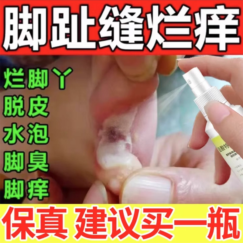 [达克宁]盐酸特比萘芬喷雾剂1%*15ml*1瓶/盒
