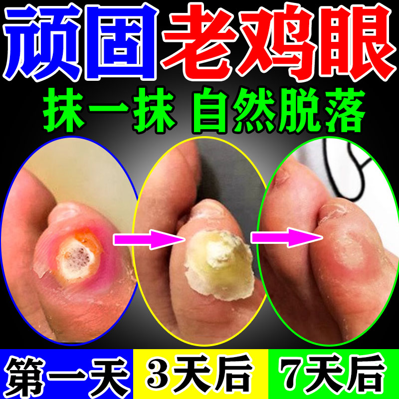 鸡眼药膏贴日本跖疣脚钉祛除寻常疣去除神器足部根脚底疣老茧肉刺