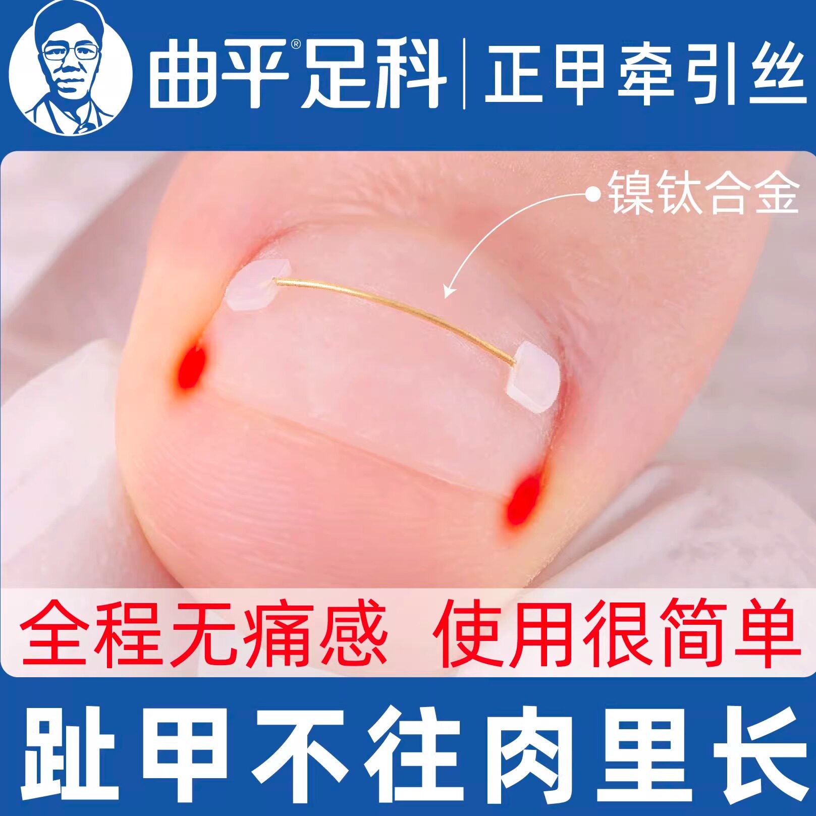 曲平医生脚趾甲甲沟嵌甲合金牵引丝弹丝矫正器正甲贴片指甲炎足科