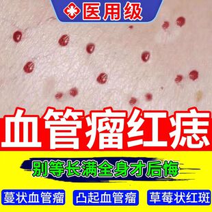 血管瘤血管痣去除樱桃状血管瘤点红痣蜘蛛痣去身上红痣黑疙瘩药膏