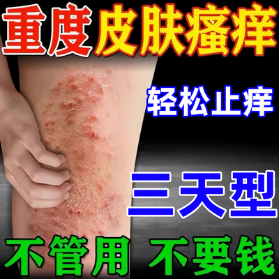 【重度瘙痒】神经性皮炎外用药膏