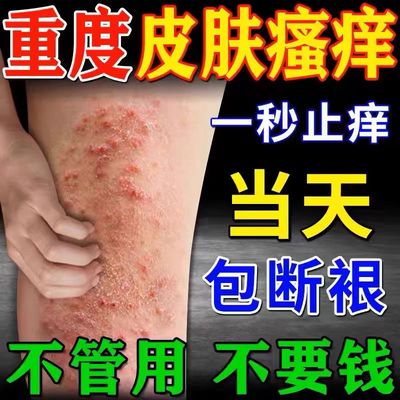 【重度瘙痒】神经性皮炎外用药膏