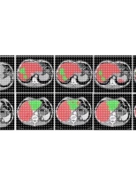 深度学习,医学图像的分割,pytorch数据集肝脏与肝肿瘤分割