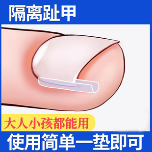 甲沟纠正神器指甲纠正器嵌甲卷甲正甲垫片脚趾甲往肉里长炎贴片