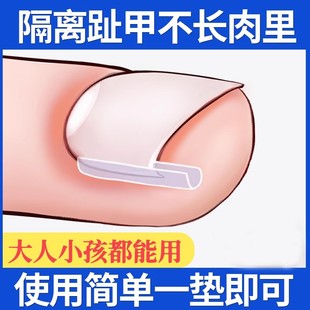 甲沟矫正神器指甲矫正器嵌甲卷甲正甲垫片脚趾甲往肉里长炎贴片