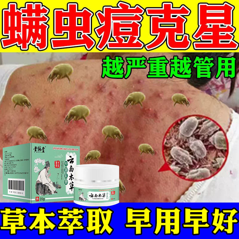 螨虫止痒特效药人用后背全身除螨脸上祛痘过敏杀菌淡化痘印专用膏