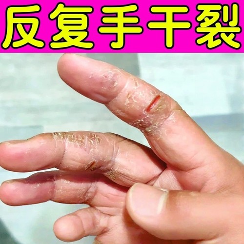 治手裂的药膏手脚干裂开裂防手足皲裂膏手裂口干燥粗糙修复护手霜