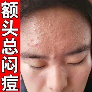额头上长痘痘男女学生内分泌失调脸部下巴起红肿熬夜豆治痘坑痘印