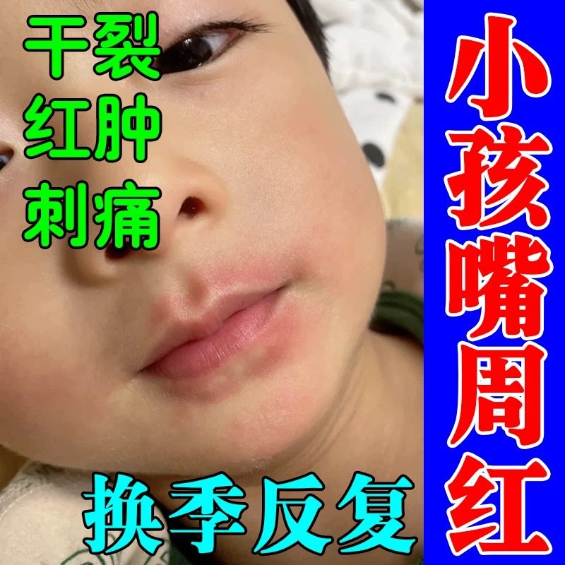 治羊胡子疮膏药儿童唇炎小孩舔嘴唇上火嘴巴起泡干裂脱皮红肿疼痛
