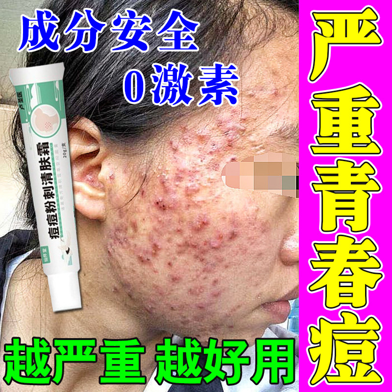 青春痘祛痘膏药痘痘修复消炎痘印