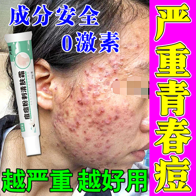 青春痘祛痘膏药痘痘修复消炎痘印