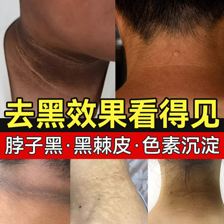 脖子黑色素去除黑棘皮症洗不干净美白神器沉淀颈部黑黑的儿童药膏