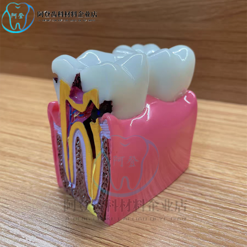 6倍龋齿牙模型健康牙齿对比模型