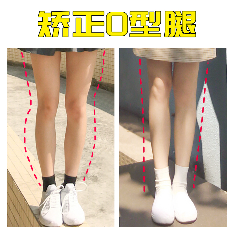 o型腿矫正神器直腿纠正小腿外翻鞋垫xo型腿x型腿矫正