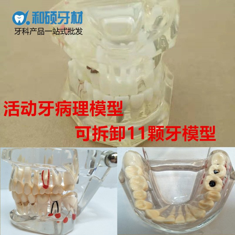 牙科 牙模型 活动牙病理模型可拆卸11颗牙齿模型 齿科