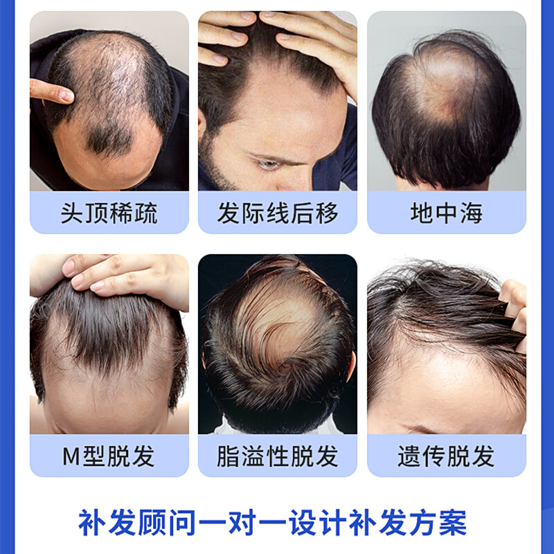 正品男假发短发男士男生全真发局部头顶补发生物头皮超薄透气M发