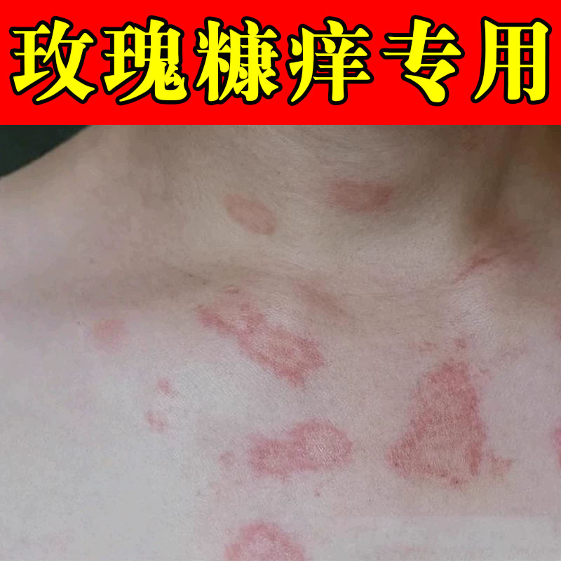 季节性玫瑰糠斑专用乳膏日光性除紫外线过敏红斑皮肤止干痒皮屑