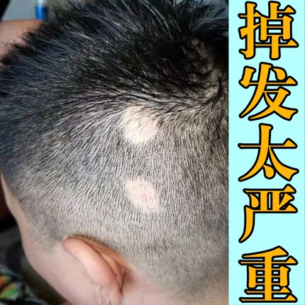 鬼剃头药儿童斑秃生发液生发增发密发成块掉地中海防脱育快速生发