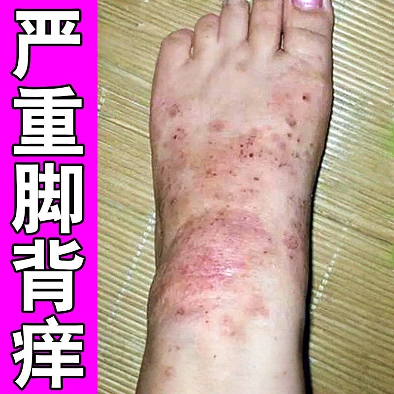 脚背痒脚背上脚面起小红点红斑红疙瘩脚杠越挠越痒的抓出血修复药