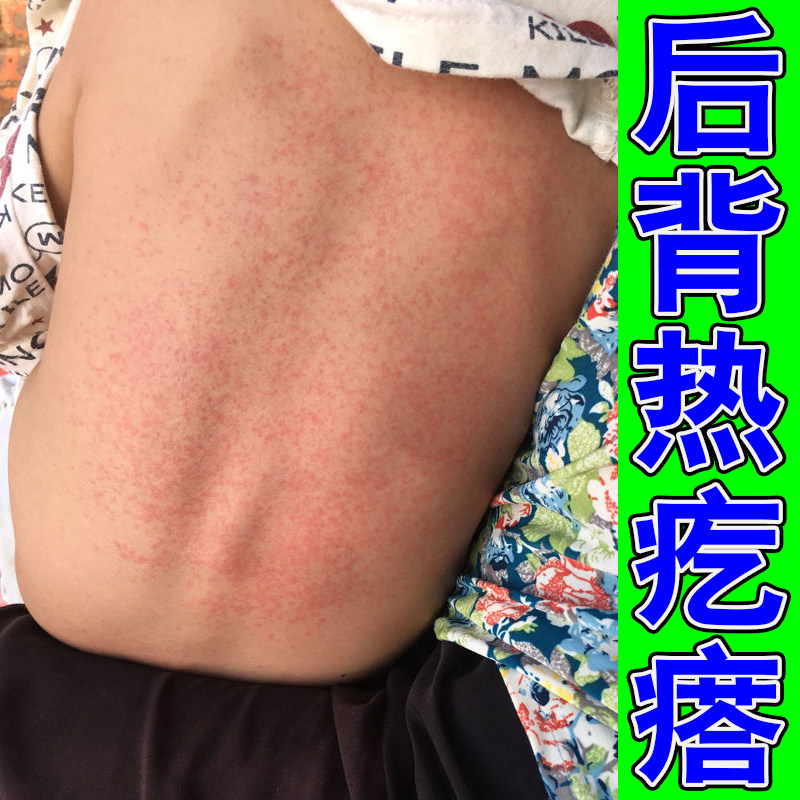 成人热痱子湿热皮痒皮干痒红点热皮肤消毒护理（消）