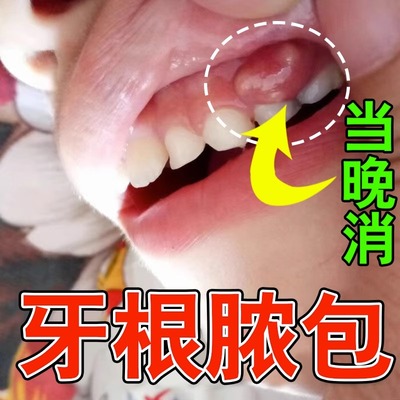 【当晚消牙龈脓包】专用喷剂