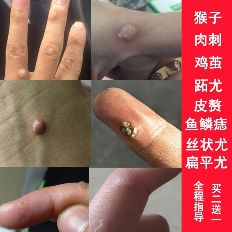祛刺肉刺去除膏去鱼鳞痣膏手部足部脚底老茧手上猴子去除鸡眼神器