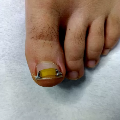 Ортопедическая траншея воспаление ногтей.