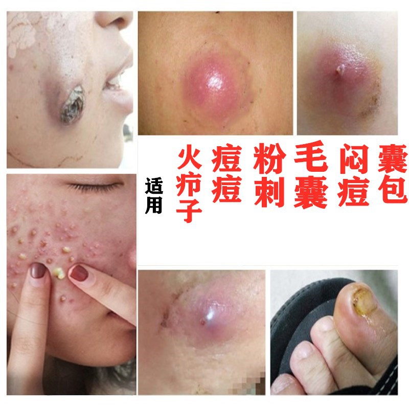 断痒b拔毒膏火疖子神器屁股坐板疮脸部皮肤浓疮包拔毒