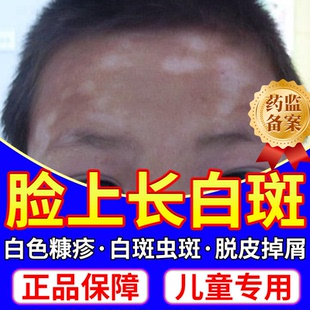 白色糠疹药膏儿童脸上长白斑长癣脸部皮肤瘙痒医用维生素e乳膏VV