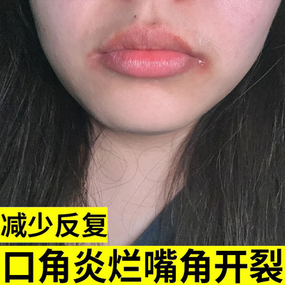【藤石制药】唇炎口角炎烂嘴角膏