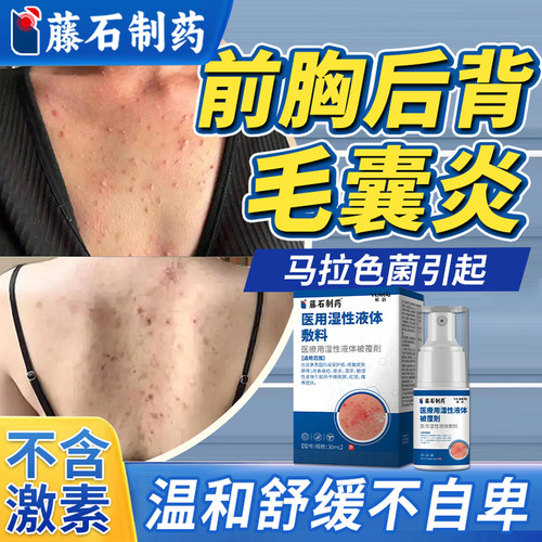 前胸后背长痘痘毛囊炎背后去除背上除螨祛痘痒马拉色菌喷雾剂KD