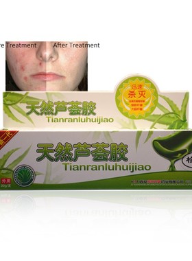 Acne aloe gel remove pimples Treatment eczema 芦荟去痘膏