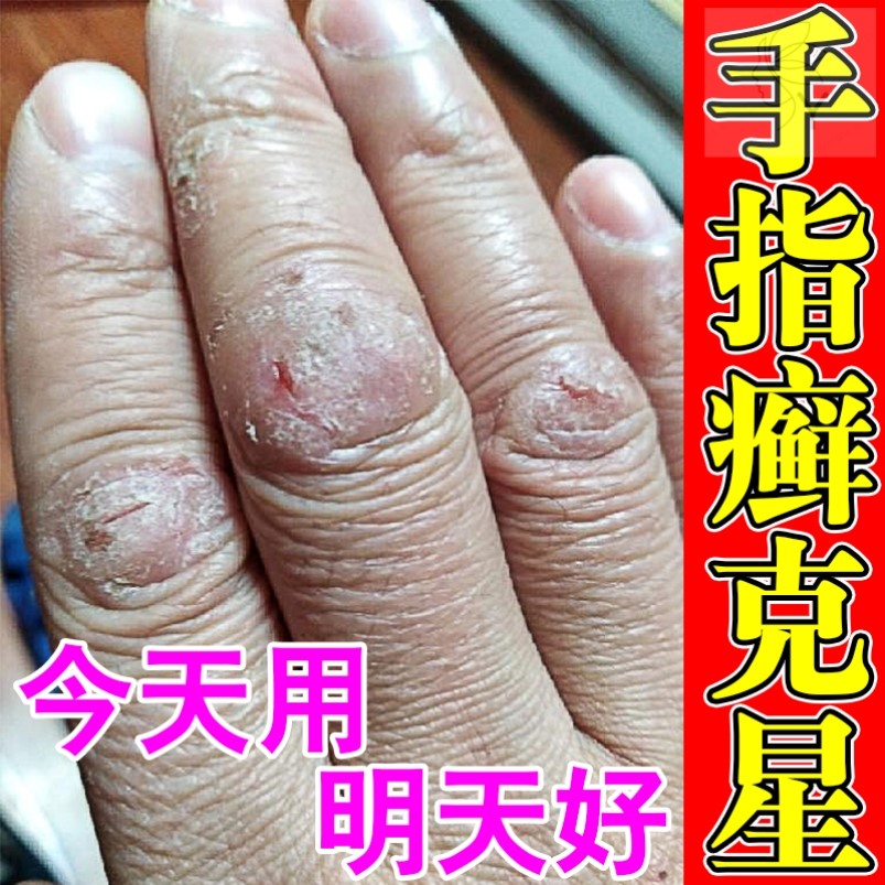 手指关节癣手指头脱皮干裂长硬疙瘩手藓手气瘙痒止痒药膏
