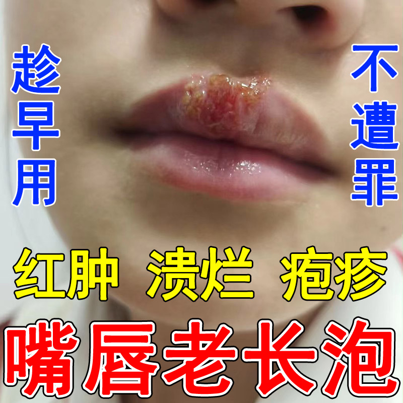 口周唇炎嘴唇干裂润唇膏