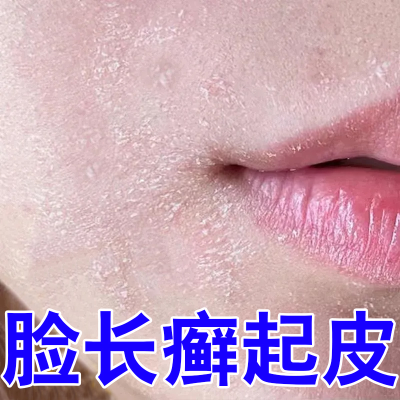 脸上起癣换季敏感眼皮面部长癣鼻子嘴角下巴红痒脱皮干燥有碎屑zy