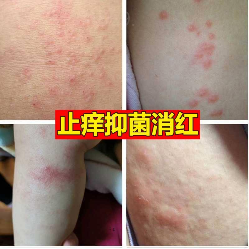 全身身上痒皮肤过敏瘙痒干燥起红疙瘩红点外用药老年