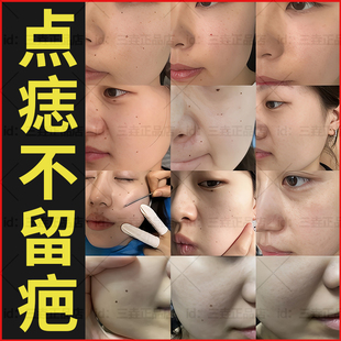 点痣药膏老古方拾痦子去痣工具国家标准醋精点痣膏官方正品不留疤