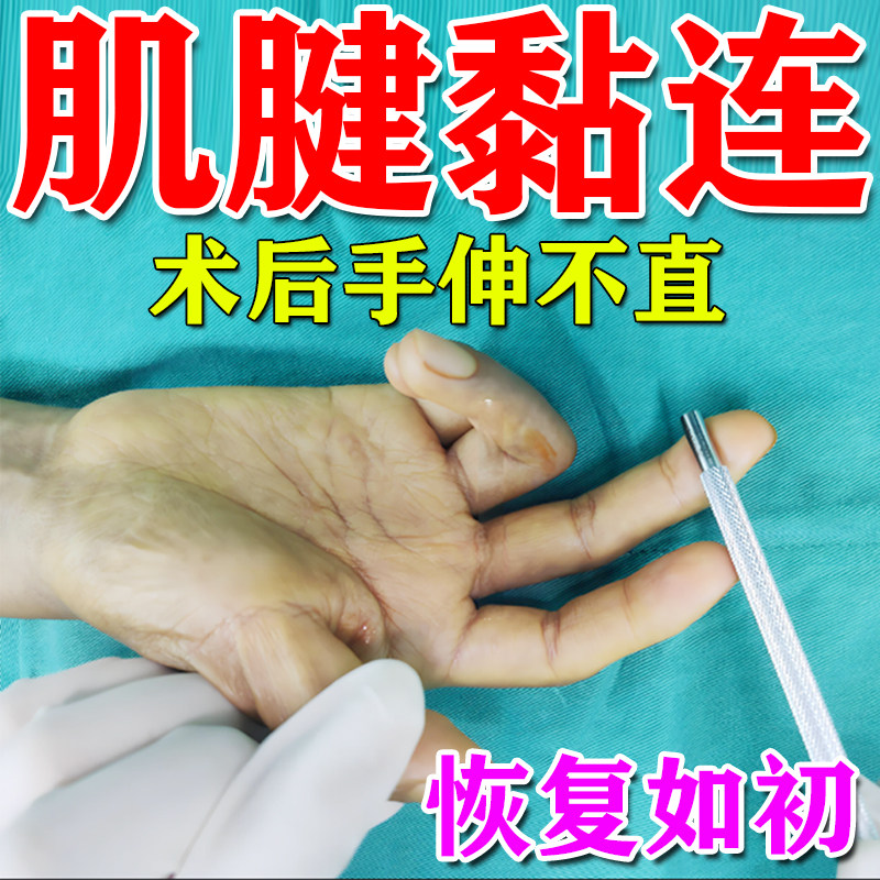 手指肌腱断裂黏连康复器恢复粘连损伤专用药膏关节僵硬伸不直药膏