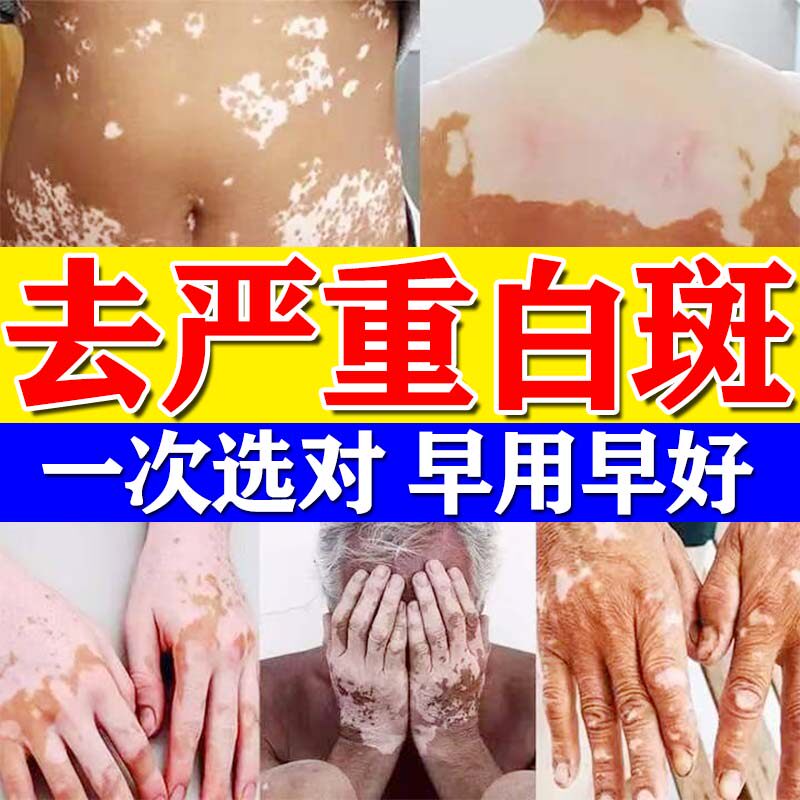 白殿风膏药快速消白斑用专治皮肤外用黑色素生长修复肤色软膏效特